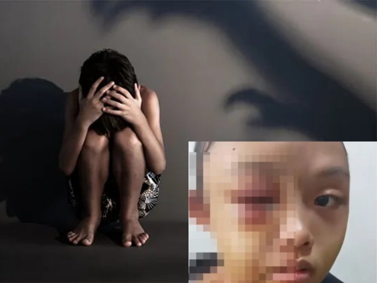VIRAL! Anak Yatim Piatu di Riau Babak Belur Dianiaya Bibi Sendiri, Tidur di Gudang dan Tak Diberi Makan